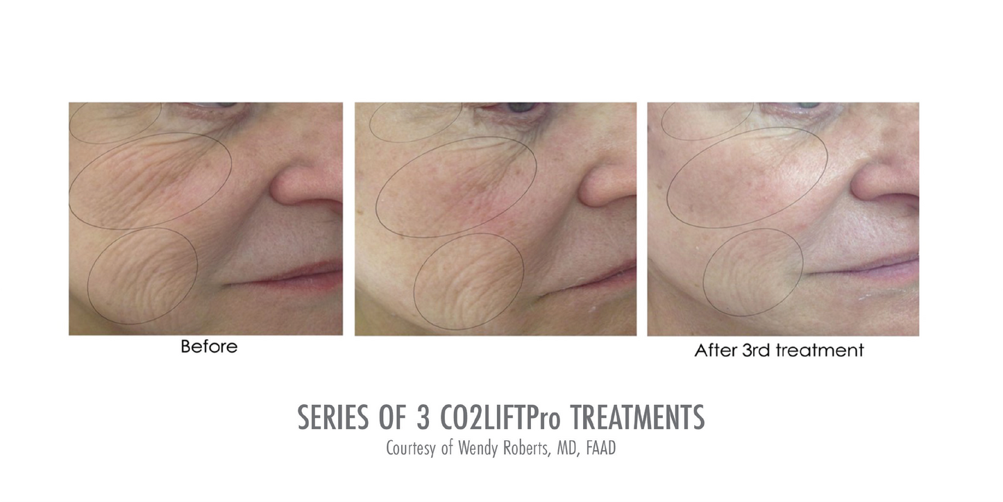 Co2 Lift PRO Mask Set of 3